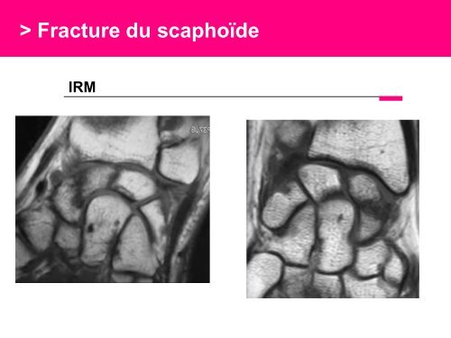 Fracture des mÃ©tacarpiens