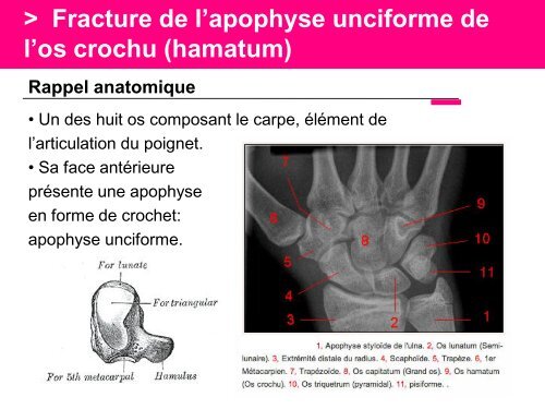 Fracture des mÃ©tacarpiens