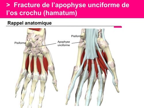 Fracture des mÃ©tacarpiens