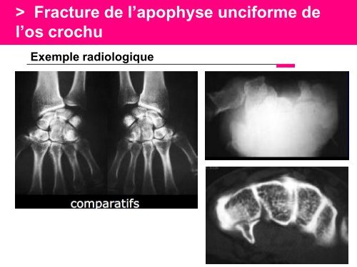 Fracture des mÃ©tacarpiens