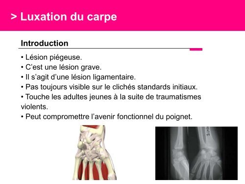 Fracture des mÃ©tacarpiens