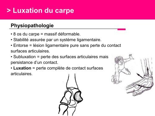 Fracture des mÃ©tacarpiens