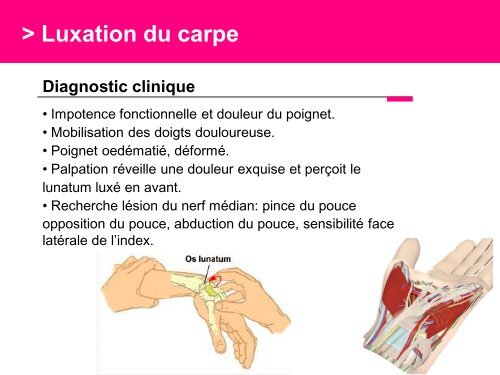 Fracture des mÃ©tacarpiens