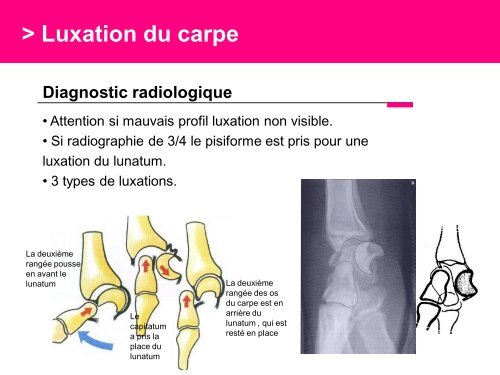 Fracture des mÃ©tacarpiens