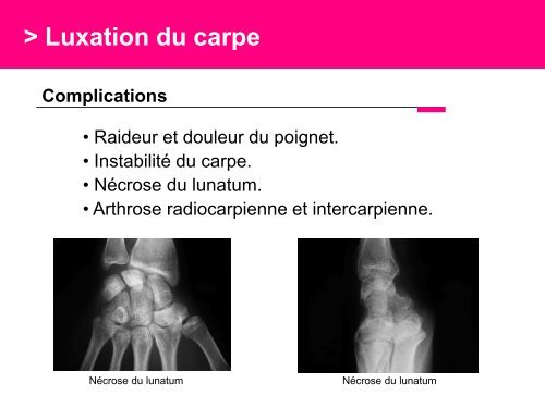 Fracture des mÃ©tacarpiens