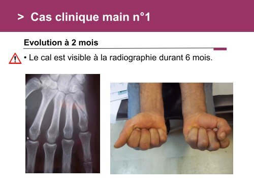 Fracture des mÃ©tacarpiens