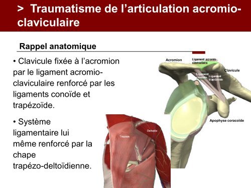 Fracture des mÃ©tacarpiens