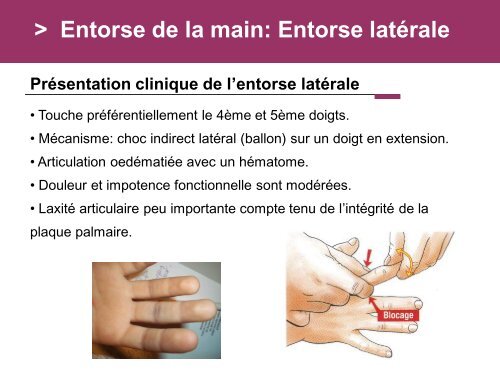 Fracture des mÃ©tacarpiens