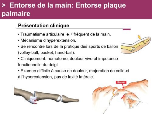 Fracture des mÃ©tacarpiens