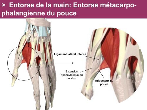 Fracture des mÃ©tacarpiens