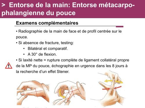 Fracture des mÃ©tacarpiens