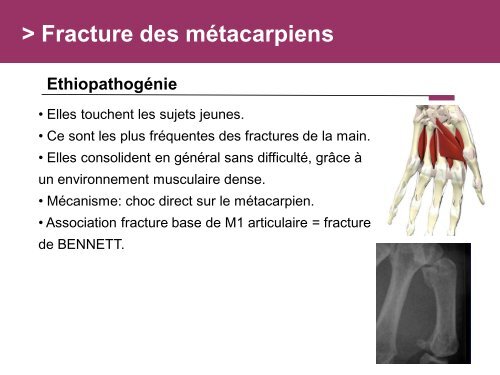 Fracture des mÃ©tacarpiens