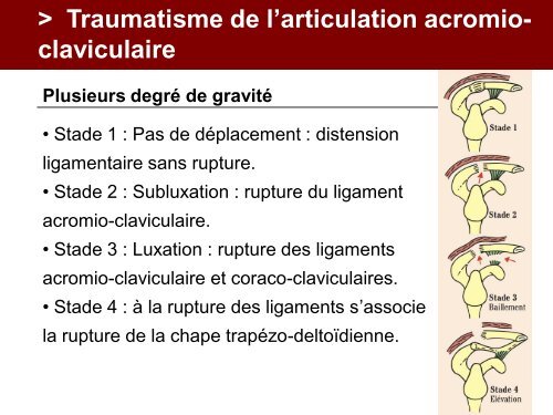 Fracture des mÃ©tacarpiens