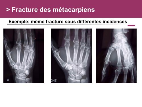 Fracture des mÃ©tacarpiens