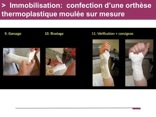 Fracture des mÃ©tacarpiens