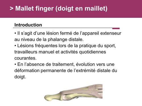 Fracture des mÃ©tacarpiens