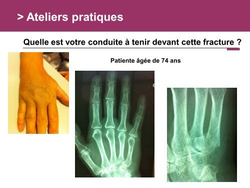 Fracture des mÃ©tacarpiens