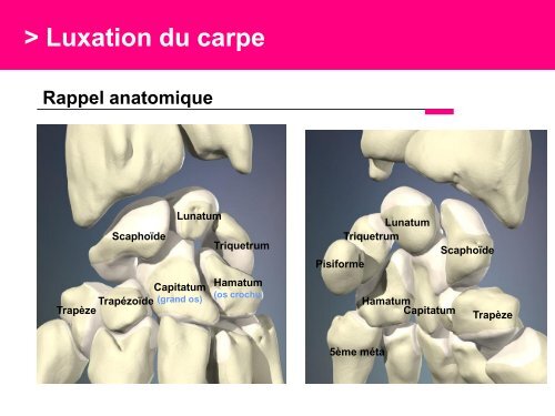 Fracture des mÃ©tacarpiens