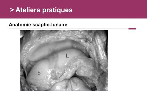 Fracture des mÃ©tacarpiens