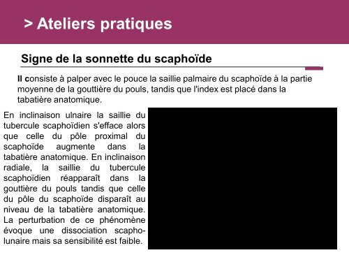 Fracture des mÃ©tacarpiens