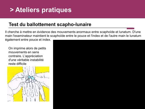 Fracture des mÃ©tacarpiens