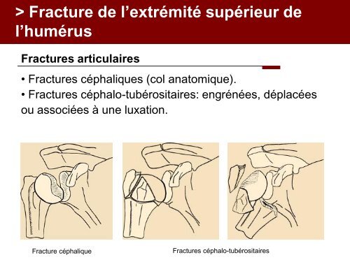 Fracture des mÃ©tacarpiens