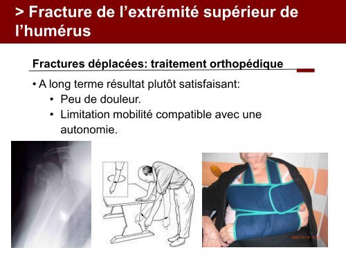 Fracture des mÃ©tacarpiens