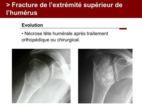 Fracture des mÃ©tacarpiens