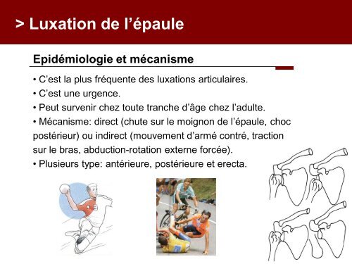 Fracture des mÃ©tacarpiens