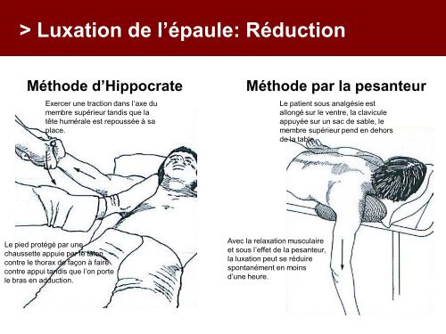 Fracture des mÃ©tacarpiens