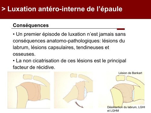 Fracture des mÃ©tacarpiens