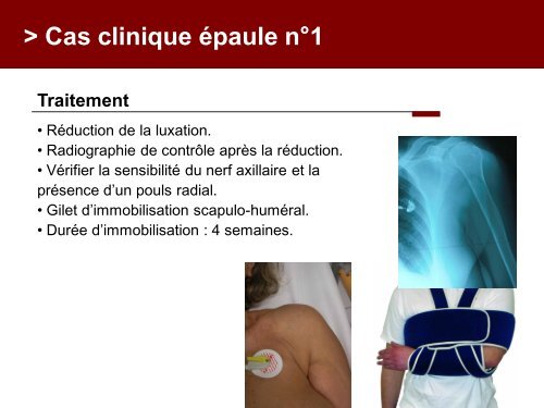 Fracture des mÃ©tacarpiens