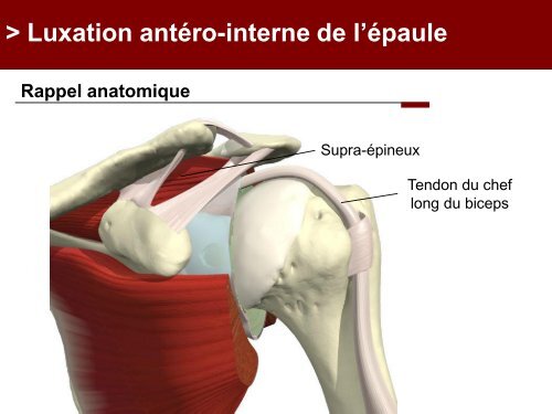 Fracture des mÃ©tacarpiens