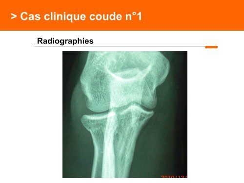 Fracture des mÃ©tacarpiens