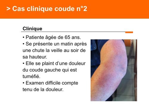 Fracture des mÃ©tacarpiens