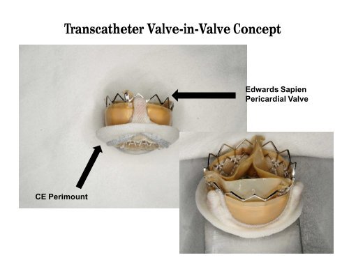 Transapical Transcatheter Mitral Valve-in-Valve Implantation: A ...