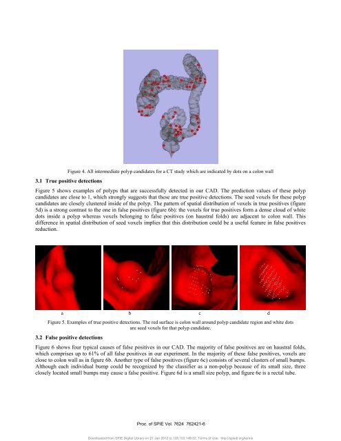 An open source implementation of colon CAD in 3D Slicer