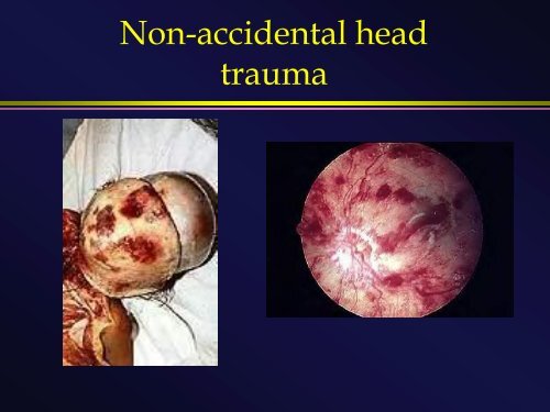 Head injury in children: From Lumps and Bumps to Bolts