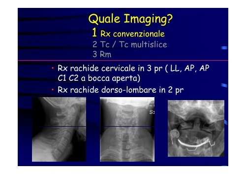 D l Diagnostica per immagini nel trauma vertebro midollare trauma ...