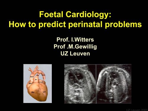 Foetal Cardiology: How to predict perinatal problems - UZ Leuven