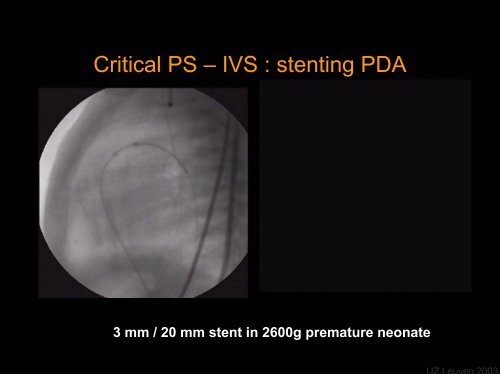 Foetal Cardiology: How to predict perinatal problems - UZ Leuven