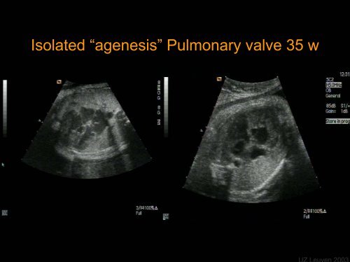 Foetal Cardiology: How to predict perinatal problems - UZ Leuven