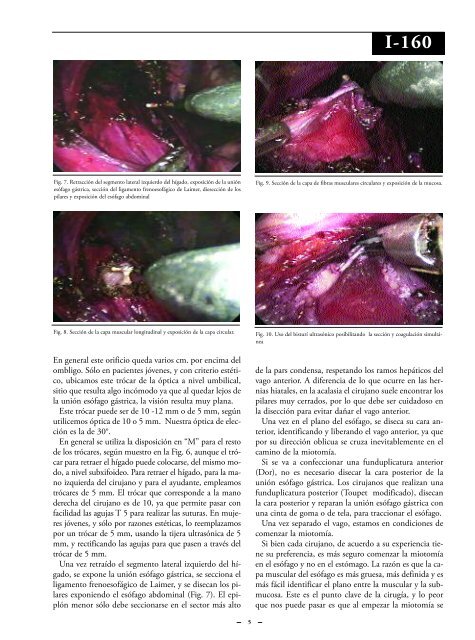 Tratamiento por vÃ­a videolaparoscÃ³pica de la acalasia ... - sacd.org.ar