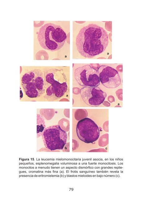 Anomalias-morfologicas-de-los-leucocitos-en-el-nino.-Aspecto-en-el-frotis-completo
