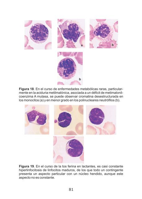 Anomalias-morfologicas-de-los-leucocitos-en-el-nino.-Aspecto-en-el-frotis-completo