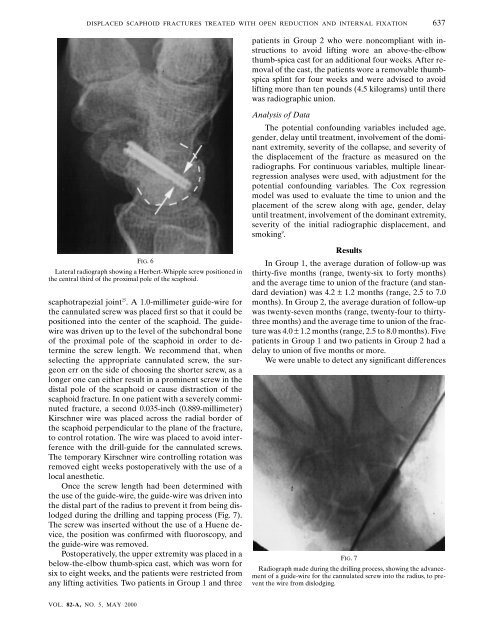 Fixation with a Cannulated Screw Displaced Scaphoid Fractures ...