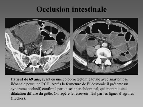 Imagerie des coloproctectomies totales avec anastomose ilÃ©oanale