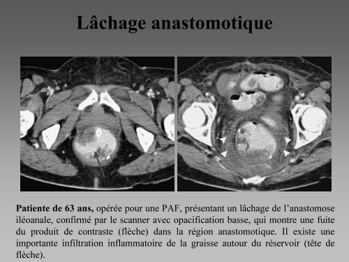 Imagerie des coloproctectomies totales avec anastomose ilÃ©oanale