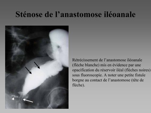 Imagerie des coloproctectomies totales avec anastomose ilÃ©oanale