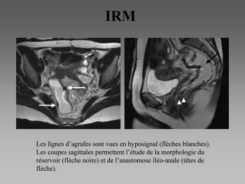 Imagerie des coloproctectomies totales avec anastomose ilÃ©oanale